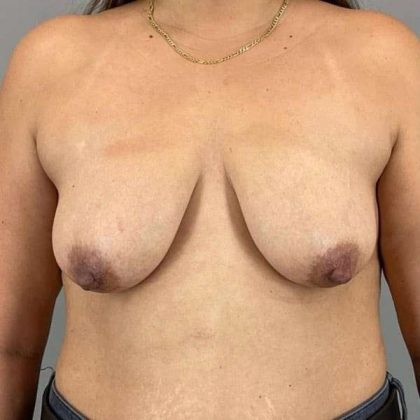 Breast Lift Before & After Patient #1109