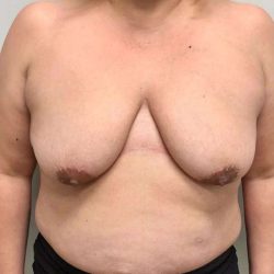 Breast Lift Before & After Patient #1120