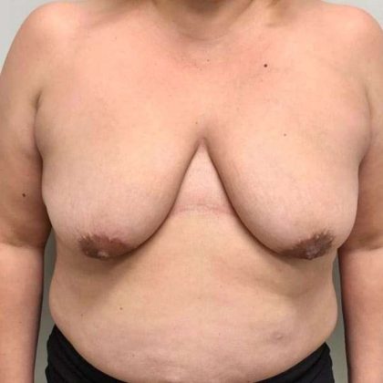 Breast Lift Before & After Patient #1120