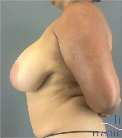 Breast Lift Before & After Patient #1131