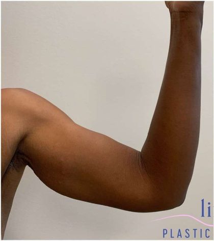 Arm Lift Before & After Patient #193
