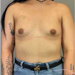 Breast Augmentation Before & After Patient #1219