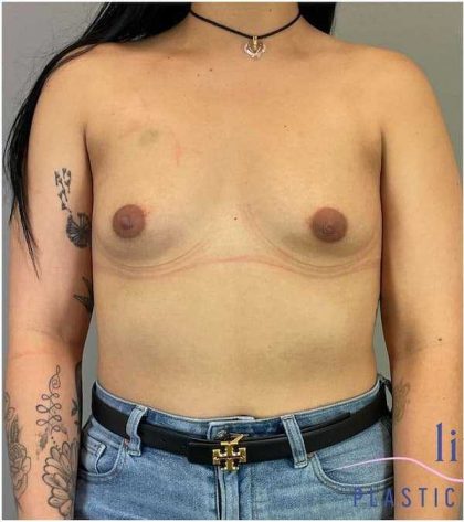 Breast Augmentation Before & After Patient #1219