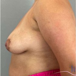 Breast Augmentation Before & After Patient #1230