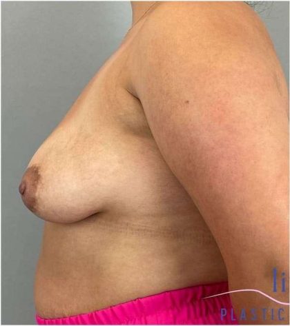 Breast Augmentation Before & After Patient #1230