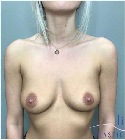 Breast Augmentation Before & After Patient #1241