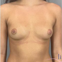Breast Augmentation Before & After Patient #1252