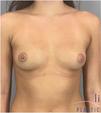 Breast Augmentation Before & After Patient #1252