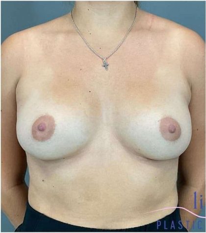 Breast Augmentation Before & After Patient #1263