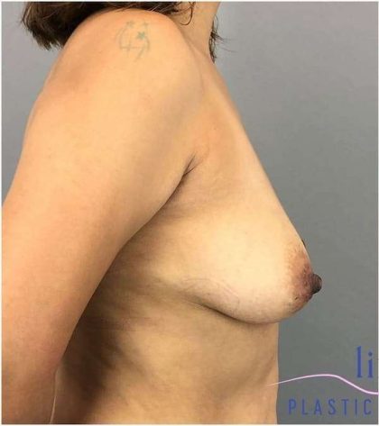 Breast Augmentation Before & After Patient #1274