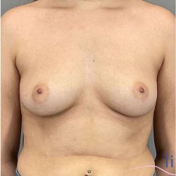 Breast Augmentation Before & After Patient #1285