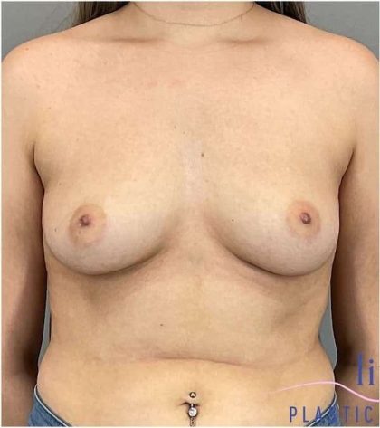 Breast Augmentation Before & After Patient #1285