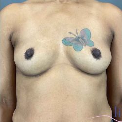 Breast Augmentation Before & After Patient #1296