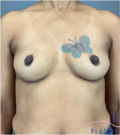 Breast Augmentation Before & After Patient #1296