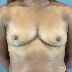 Breast Augmentation Before & After Patient #1307
