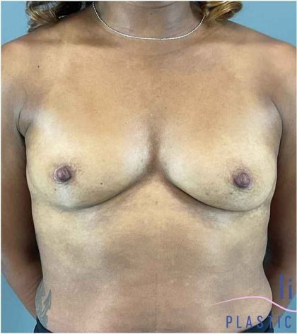 Breast Augmentation Before & After Patient #1307