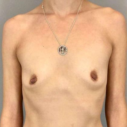 Breast Augmentation Before & After Patient #1329