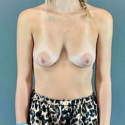 Breast Augmentation Before & After Patient #1340