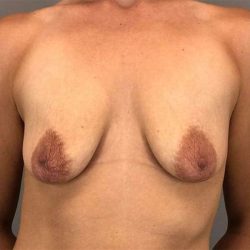 Breast Augmentation Before & After Patient #1351