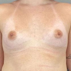 Breast Augmentation Before & After Patient #1362