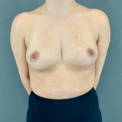 Breast Augmentation Before & After Patient #1406