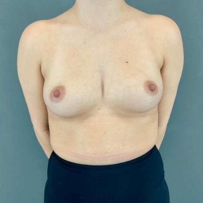 Breast Augmentation Before & After Patient #1406