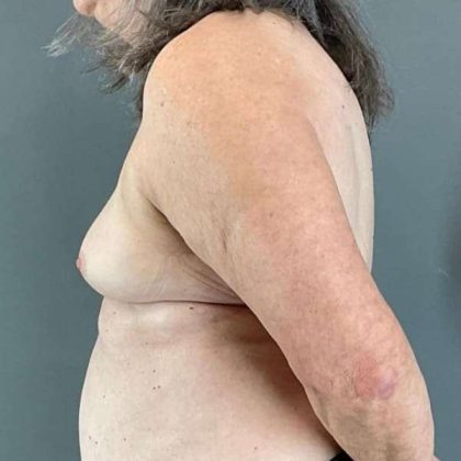 Breast Augmentation Before & After Patient #1450