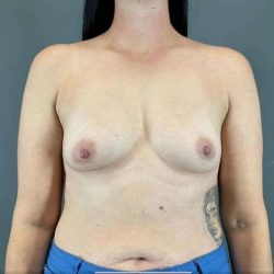 Breast Augmentation Before & After Patient #1472