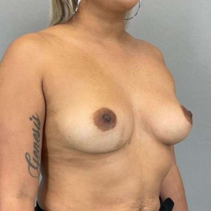 Breast Augmentation Before & After Patient #1483