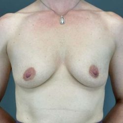Breast Augmentation Before & After Patient #1547