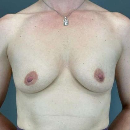 Breast Augmentation Before & After Patient #1547