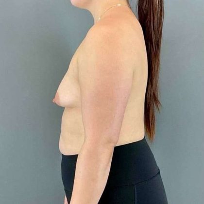 Breast Augmentation Before & After Patient #1591