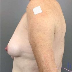 Breast Augmentation Before & After Patient #1613