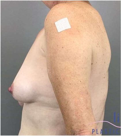 Breast Augmentation Before & After Patient #1613