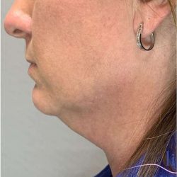 Necktite Before & After Patient #1624