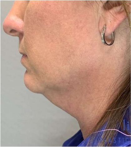 Necktite Before & After Patient #1624
