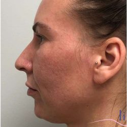 Necktite Before & After Patient #1642