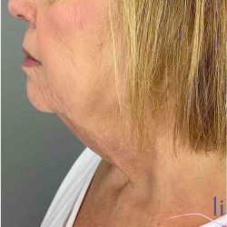 Neck Lift Before & After Patient #1649
