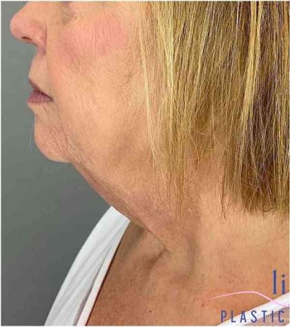 Neck Lift Before & After Patient #1649