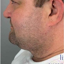 Neck Lift Before & After Patient #1660