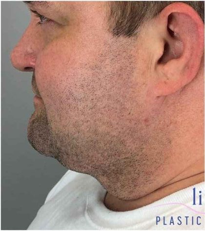 Neck Lift Before & After Patient #1660