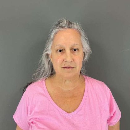 Neck Lift Before & After Patient #1671