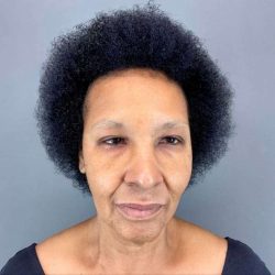 Neck Lift Before & After Patient #1685