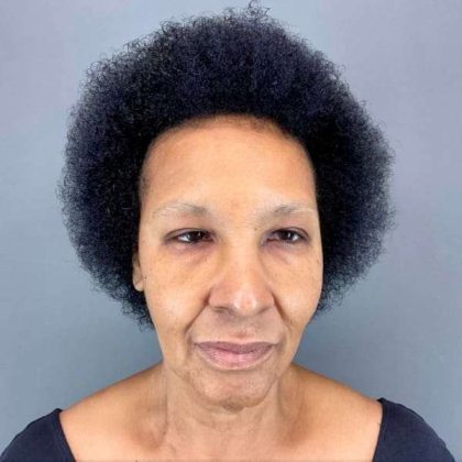 Neck Lift Before & After Patient #1685