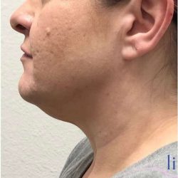 Neck Lift Before & After Patient #1696