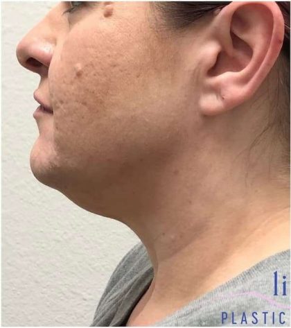 Neck Lift Before & After Patient #1696