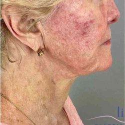 Facelift Before & After Patient #1703