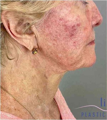 Facelift Before & After Patient #1703