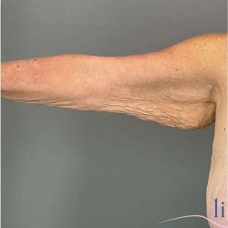Arm Lift Before & After Patient #222