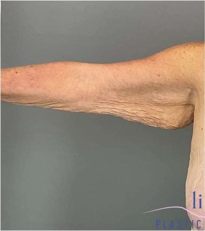 Arm Lift Before & After Patient #222